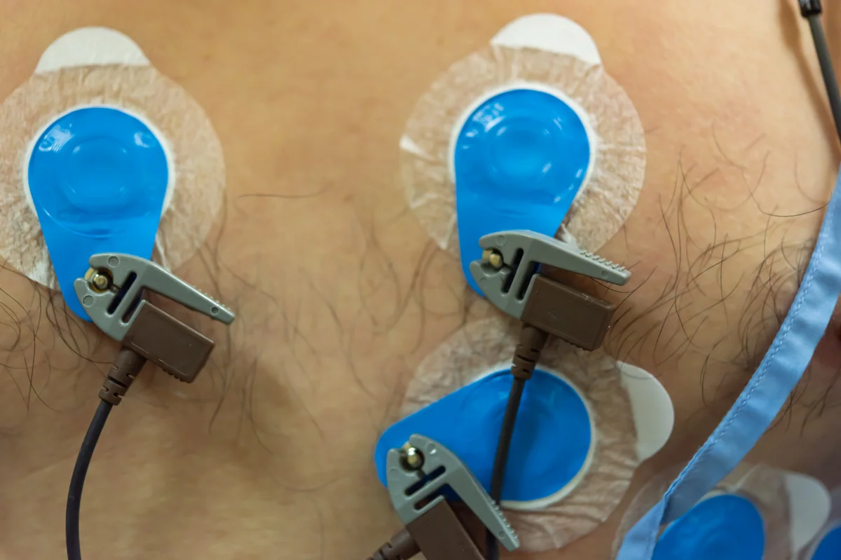 Close-up of ECG electrodes taped to a patient's chest with clips and leads attached